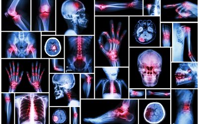 My broken bone surgery, cleansing kale recipe and hints for fall cleansing